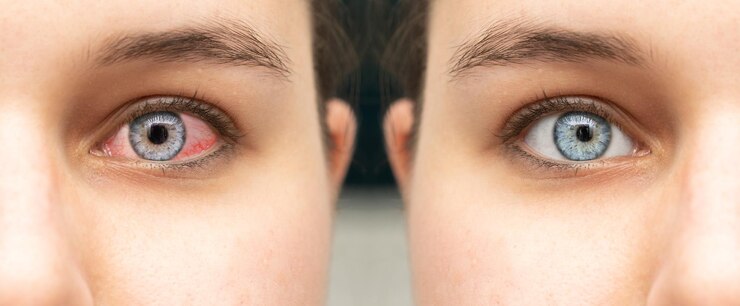 Pink Eye Symptoms vs Allergy Eyes: What's the Difference?